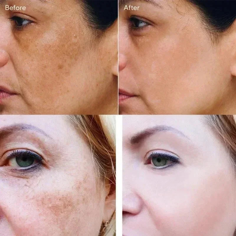 Injuste-Sérum blanchissant pour le visage, élimine les taches foncées et les taches de rousseur, correcteur de mélanine, anti-pigmentation, éclaircit la peau, produits de soins de beauté