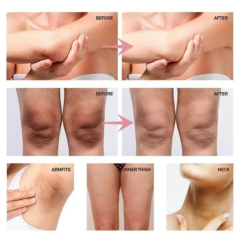Crème hydratante pour le corps, blanchissante, pour les aisselles, pour les fesses et les genoux, parties intimes, mélanine, éclaircissante, soins pour la peau foncée, beauté pour femmes