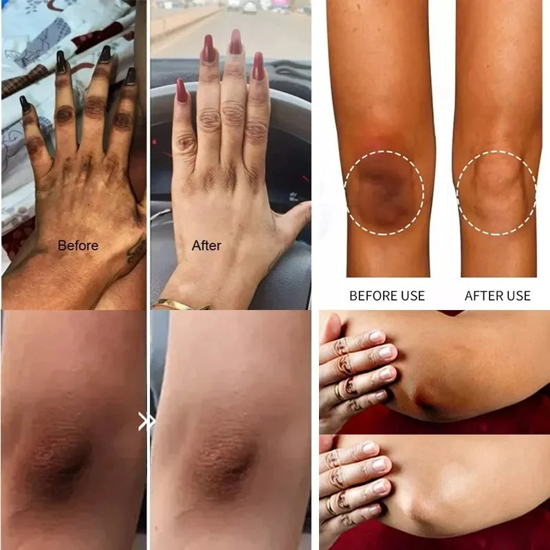 Crème hydratante pour le corps, blanchissante, pour les aisselles, pour les fesses et les genoux, parties intimes, mélanine, éclaircissante, soins pour la peau foncée, beauté pour femmes
