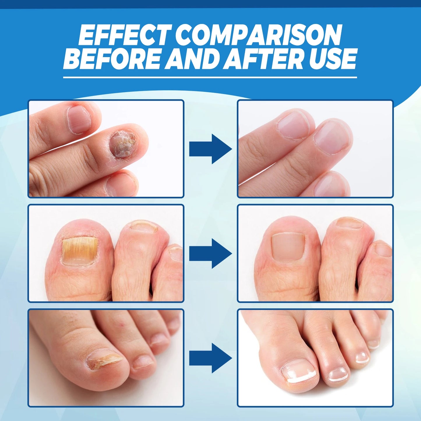 Stylo Laser pour le corps sain, outil de soins des pieds des jambes pour vous entretenir le bien-être optimal