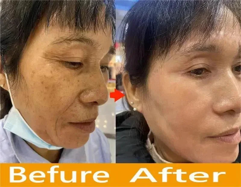 Injuste-Sérum blanchissant pour le visage, élimine les taches foncées et les taches de rousseur, correcteur de mélanine, anti-pigmentation, éclaircit la peau, produits de soins de beauté