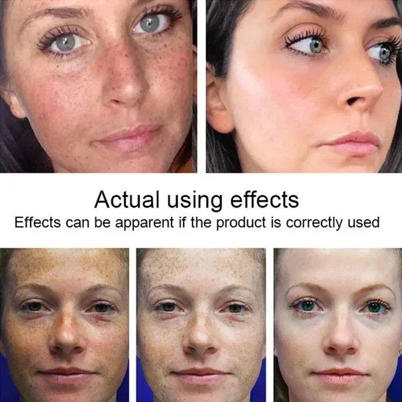 Injuste-Sérum blanchissant pour le visage, élimine les taches foncées et les taches de rousseur, correcteur de mélanine, anti-pigmentation, éclaircit la peau, produits de soins de beauté