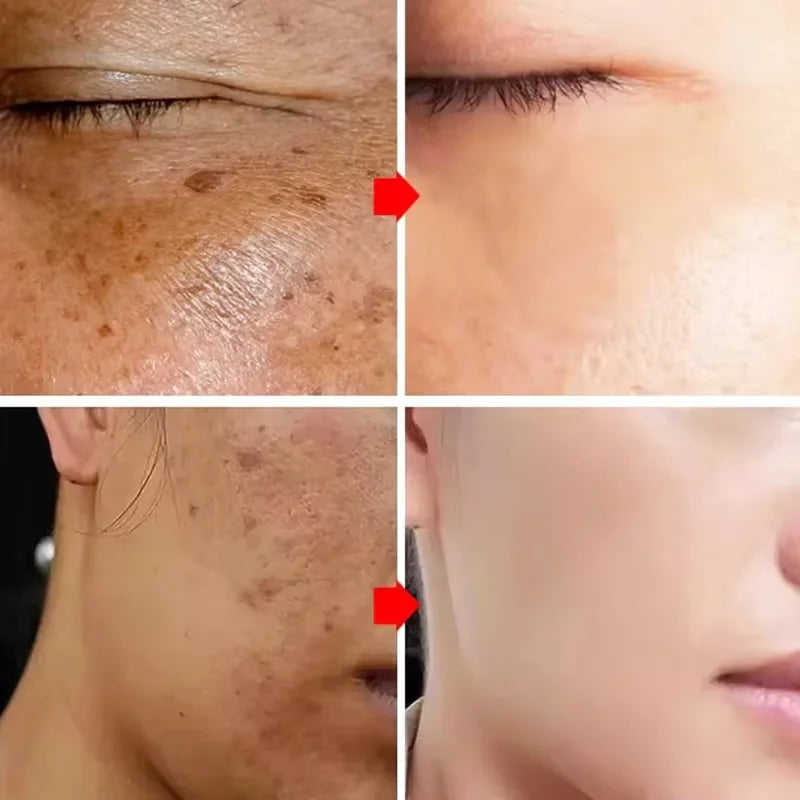 Injuste-Sérum blanchissant pour le visage, élimine les taches foncées et les taches de rousseur, correcteur de mélanine, anti-pigmentation, éclaircit la peau, produits de soins de beauté