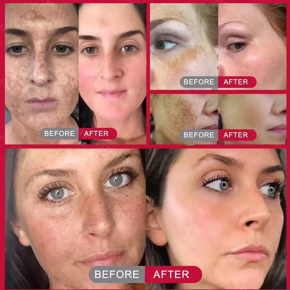 Injuste-Sérum blanchissant pour le visage, élimine les taches foncées et les taches de rousseur, correcteur de mélanine, anti-pigmentation, éclaircit la peau, produits de soins de beauté